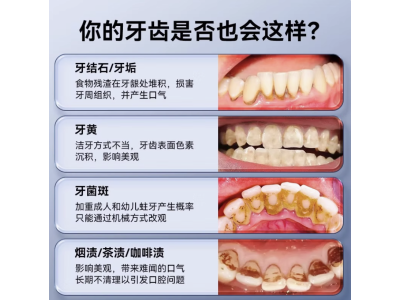 德国可视真超声波洁牙器洗牙齿污垢除牙结石神器家用洁牙仪冲牙器图3